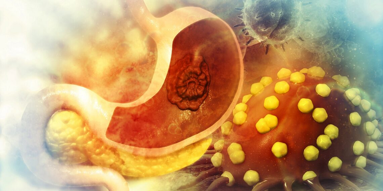 Mide Kanseri hastalarını umutlandıracak haber Çin'den geldi!